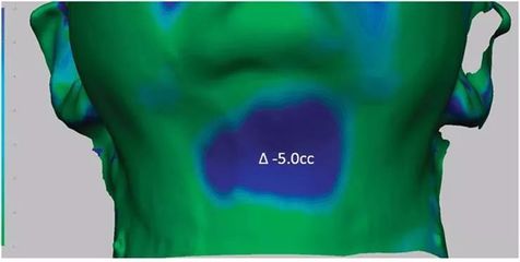 3D成像評(píng)估注射溶脂/冷凍溶脂后頦下脂肪消除情況